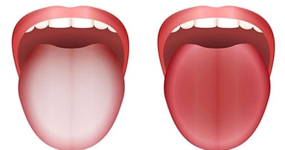 زبان سفید چه چیزی درباره سلامت میگوید؟ 1 2204982 693 چی تو وب